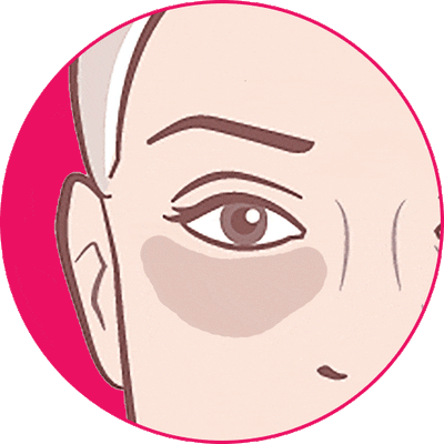 Under-Eye Bags